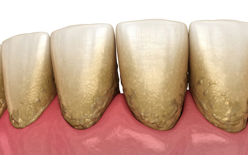 歯石とは